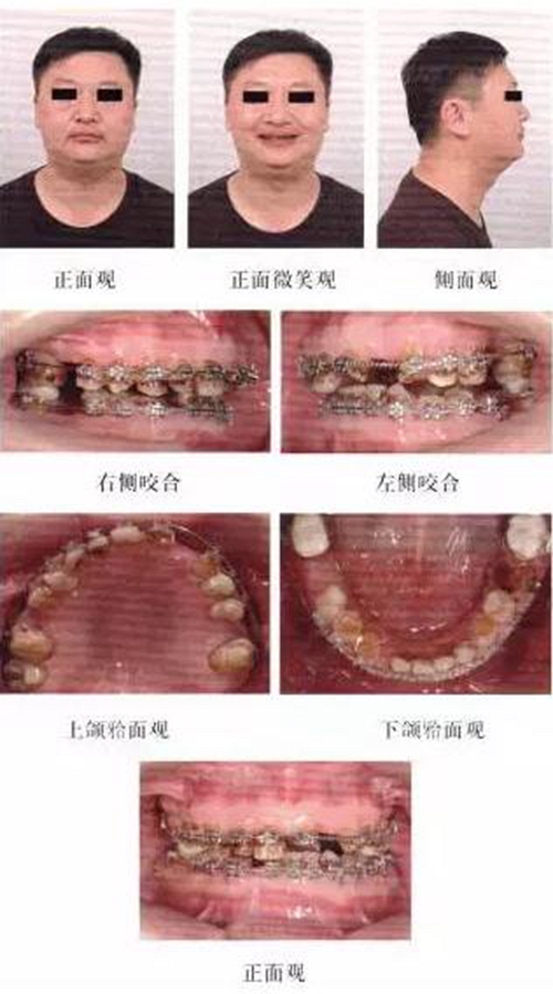 正畸修復聯(lián)合咬合重建1例 