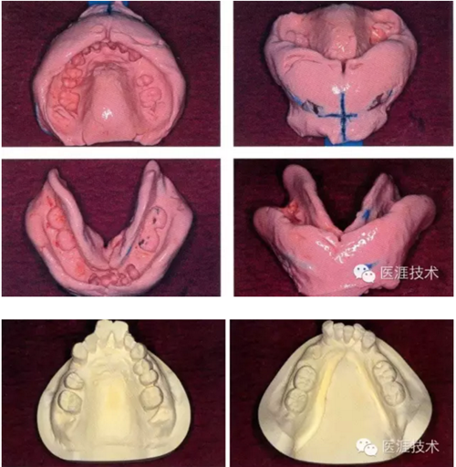 全口拔牙即戴全口活動(dòng)義齒修復(fù)病例 