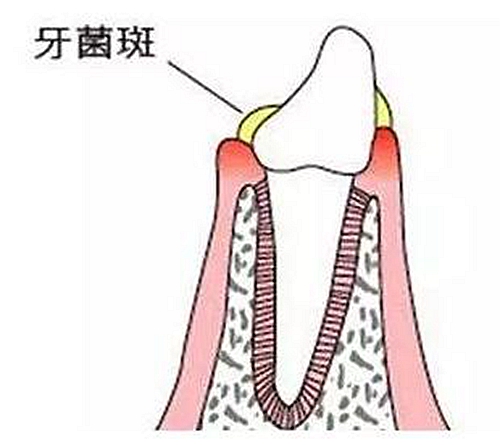 牙周病患者的外提升 梁光強(qiáng)