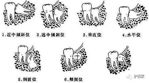 智齒一定要拔嗎?