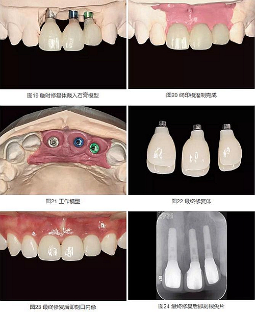 上頜多顆相鄰前牙的“精確化”即刻種植修復(fù)