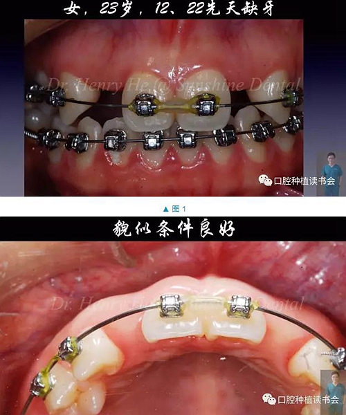短種植體在前牙美學區(qū)應用的臨床病例報道（上）