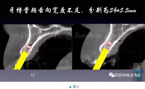 短種植體在前牙美學區(qū)應用的臨床病例報道（上）