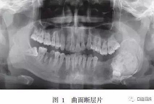 下頜骨骨化纖維瘤并發(fā)組合性牙瘤1例