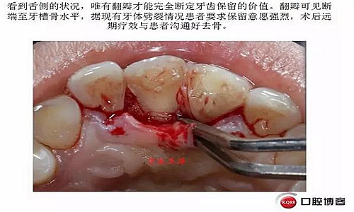 前牙外傷冠延長(zhǎng)+全瓷冠修復(fù)