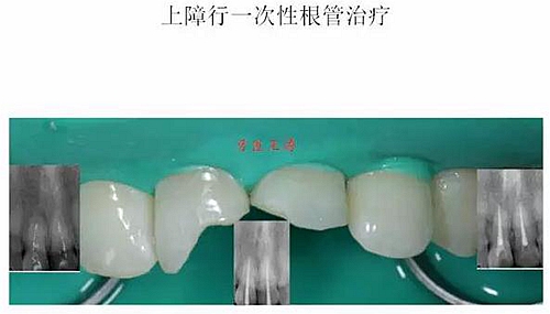 前牙外傷冠延長(zhǎng)+全瓷冠修復(fù)