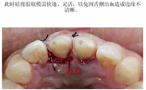 前牙外傷冠延長(zhǎng)+全瓷冠修復(fù)