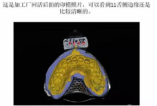 前牙外傷冠延長(zhǎng)+全瓷冠修復(fù)