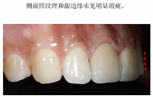 前牙外傷冠延長(zhǎng)+全瓷冠修復(fù)