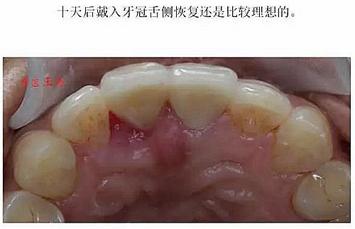 前牙外傷冠延長(zhǎng)+全瓷冠修復(fù)