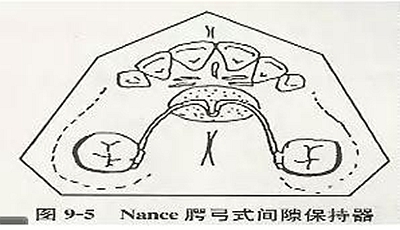 【牙醫(yī)干貨】各種間隙保持器賞析