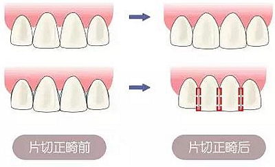 醫(yī)生方案里的鄰面去釉，究竟是什么？