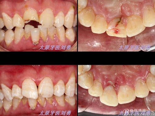劉勇：斷牙再粘結(jié)兩例病例 