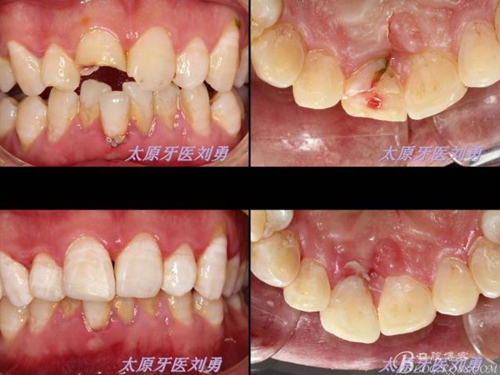 劉勇：斷牙再粘結(jié)兩例病例 