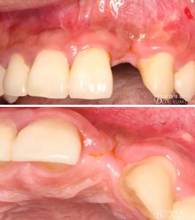 一例上前牙種植失敗病例的補(bǔ)救