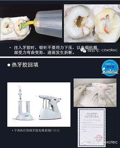 【現(xiàn)代根管治療】之熱牙膠充填技術(shù)