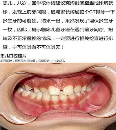 多生牙的拔除總原則：早發(fā)現(xiàn)，早處理！