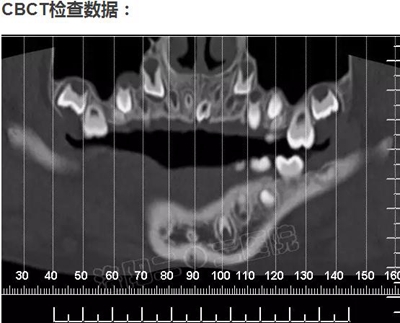 多生牙的拔除總原則：早發(fā)現(xiàn)，早處理！