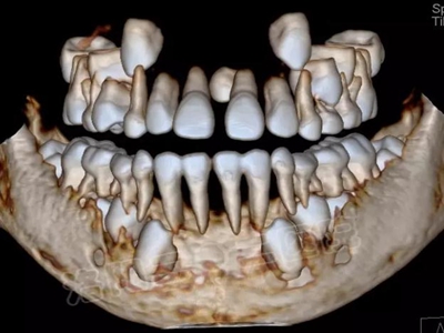 多生牙的拔除總原則：早發(fā)現(xiàn)，早處理！