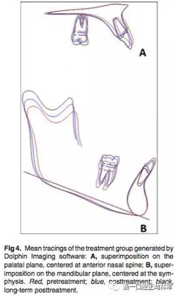 正畸文獻(xiàn)閱讀--用Jasper跳躍矯治器治療II類患者的長期穩(wěn)定性