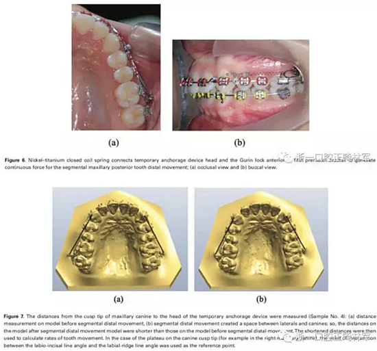 正畸文獻閱讀-兩種不同矯治力下上頜后牙段遠移的生化與臨床比較