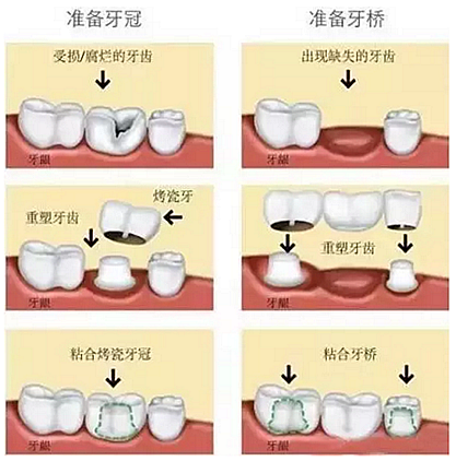 一位資深牙醫(yī)的總結(jié) | 如何減輕患者鑲牙后酸痛癥狀的措施！