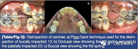 文獻(xiàn)優(yōu)秀正畸病例賞析--牙周加速成骨正畸（PAOO）輔助的腭側(cè)埋伏尖牙牽引矯治及5年跟蹤隨訪