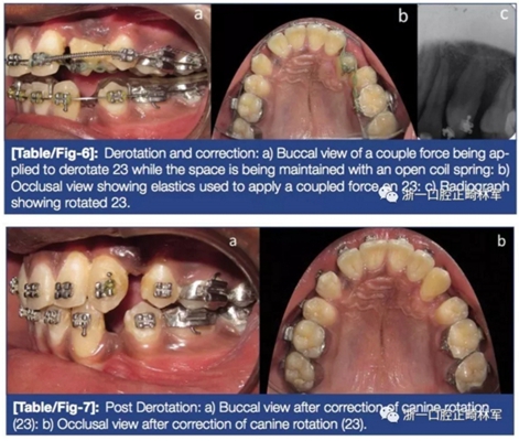 文獻(xiàn)優(yōu)秀正畸病例賞析--牙周加速成骨正畸（PAOO）輔助的腭側(cè)埋伏尖牙牽引矯治及5年跟蹤隨訪
