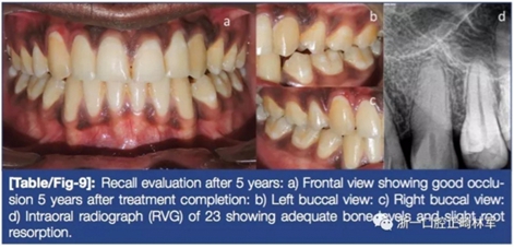 文獻(xiàn)優(yōu)秀正畸病例賞析--牙周加速成骨正畸（PAOO）輔助的腭側(cè)埋伏尖牙牽引矯治及5年跟蹤隨訪