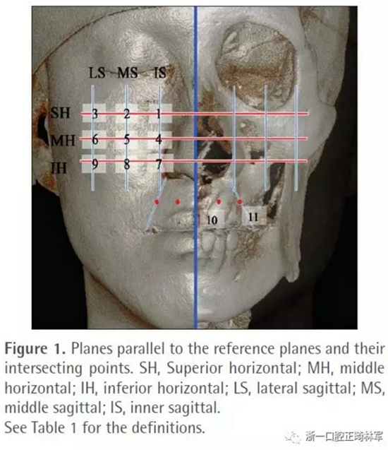 正畸文獻(xiàn)閱讀--無(wú)癥狀單側(cè)唇腭裂患者面中部不對(duì)稱的三維分析