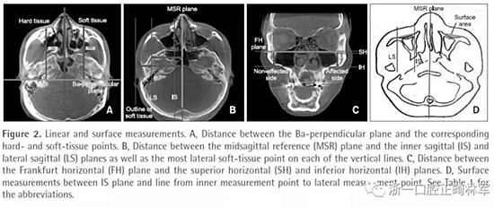 正畸文獻(xiàn)閱讀--無(wú)癥狀單側(cè)唇腭裂患者面中部不對(duì)稱的三維分析