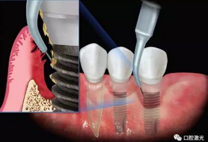 種植體周圍炎的激光療法