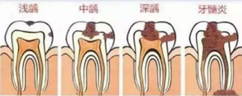 當(dāng)心“腹黑”齲齒，牙齒有個(gè)小洞也要補(bǔ)！