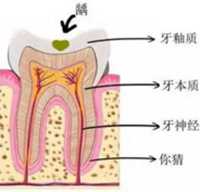 當(dāng)心“腹黑”齲齒，牙齒有個(gè)小洞也要補(bǔ)！