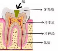 當(dāng)心“腹黑”齲齒，牙齒有個(gè)小洞也要補(bǔ)！