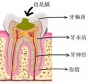 當(dāng)心“腹黑”齲齒，牙齒有個(gè)小洞也要補(bǔ)！