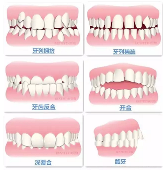 【口腔科普】關(guān)于矯牙前、中、后需要注意的問題，了解一下？