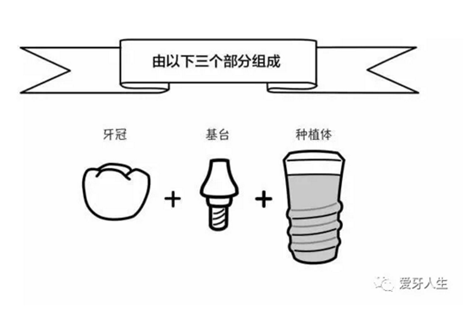 如何選擇種植牙，給《患者》推薦這篇文章就足矣