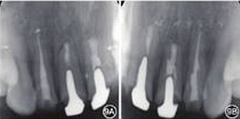 【病例討論】根管治療失敗患牙再治療一例（下）
