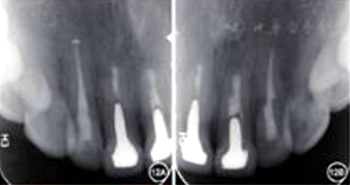 【病例討論】根管治療失敗患牙再治療一例（下）