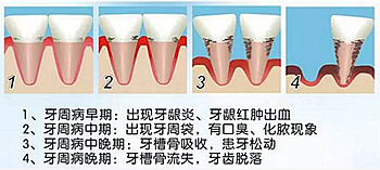 牙周病發(fā)展過(guò)程