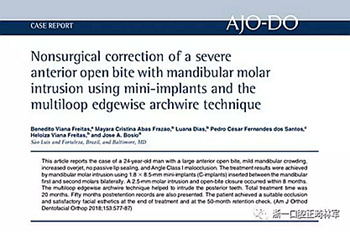 文獻(xiàn)優(yōu)秀正畸病例賞析-通過微種植釘及多曲方絲技術(shù)壓低下頜磨牙非手術(shù)矯治嚴(yán)重前牙開合患者1例