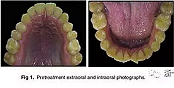 文獻(xiàn)優(yōu)秀正畸病例賞析-通過微種植釘及多曲方絲技術(shù)壓低下頜磨牙非手術(shù)矯治嚴(yán)重前牙開合患者1例