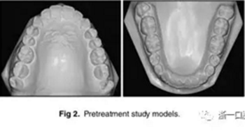 文獻(xiàn)優(yōu)秀正畸病例賞析-通過微種植釘及多曲方絲技術(shù)壓低下頜磨牙非手術(shù)矯治嚴(yán)重前牙開合患者1例