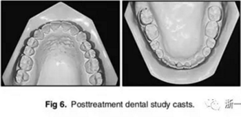 文獻(xiàn)優(yōu)秀正畸病例賞析-通過微種植釘及多曲方絲技術(shù)壓低下頜磨牙非手術(shù)矯治嚴(yán)重前牙開合患者1例