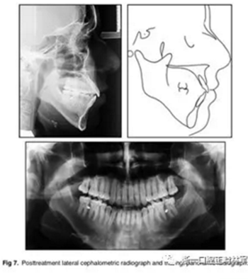 文獻(xiàn)優(yōu)秀正畸病例賞析-通過微種植釘及多曲方絲技術(shù)壓低下頜磨牙非手術(shù)矯治嚴(yán)重前牙開合患者1例