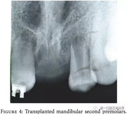 文獻優(yōu)秀正畸病例賞析--上頜中切牙區(qū)受傷后自體牙移植及正畸治療13年隨訪病例