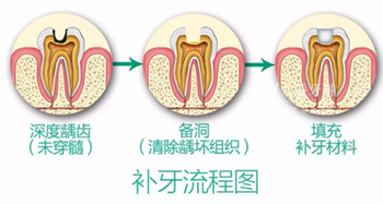 完全不懂，各種補牙材料，到底怎么選？