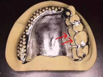 活動(dòng)義齒修復(fù)，要懂的鋼托設(shè)計(jì)
