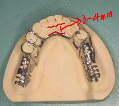 活動(dòng)義齒修復(fù)，要懂的鋼托設(shè)計(jì)